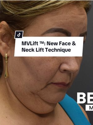 A post by @careagaplasticsurgery on TikTok caption: Dr. Paul Durand‘s MVLift™ procedure uses multiple vectors to address both deep and superficial facial structures, offering minimal bruising and a faster recovery compared to traditional face and neck lifts. ##Facelift##FaceAndNeckLift##PlasticSurgery##MiamiPlasticSurgeon##FacialRejuvenation