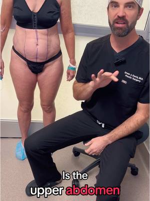 A post by @thenaturalresult on TikTok caption: #tummytuck #abdomen #skin #plasticsurgery #plasticsurgeon #skinremoval #5kids 