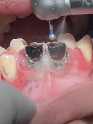 A post by @s.joramsdentalclinic3 on TikTok caption: treating teeth with composite restoration after root canal treatment #teeth #dentist #dentistry #uganda #ugandanstiktok #LearnOnTikTok 