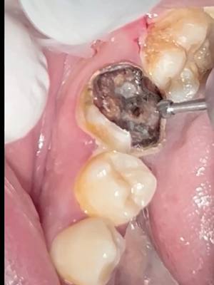 A post by @s.joramsdentalclinic3 on TikTok caption: treating deep cavity and composite restoration #teeth #dentist #dentistry #uganda #ugandanstiktok #LearnOnTikTok 