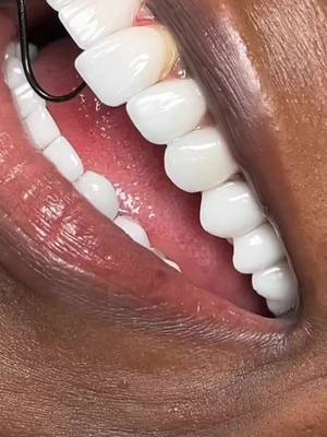 A post by @s.joramsdentalclinic3 on TikTok caption: how veneers work. best dental tips on how to have a perfect smile #dentist #veneers #teeth #dentistry #uganda #ugandanstiktok #LearnOnTikTok 