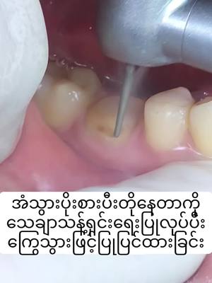 A post by @pearldentalclinic0 on TikTok caption: အံသွားတိုတိုလေးဖြစ်နေတာကိုအကောင်းတိုင်းဖြစ်အောင်ပြုပြင်ထားတာပါ#ပုလဲသွားဆေးခန်း #သွားဆေးခန်း 