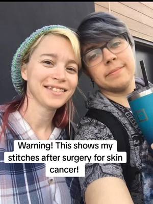 A post by @littlecheybaby on TikTok caption: ⚠️ Warning! Images of my stitches from surgery for skin cancer! ⚠️ #2024 #skincancer #petloss #cosplay #greenscreen @Allen Chai 