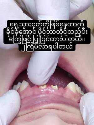 A post by @pearldentalclinic0 on TikTok caption: သွားငုတ်တိုဖြစ်နေတာကိုကြွေဖြင့်ပြုပြင်ခြင်း#ပုလဲသွားဆေးခန်း #သွားဆေးခန်း 