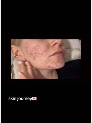 A post by @officialsamithompson on TikTok caption: sorry for the dramatic music i tried to put on read but it did not let me…anyways.  hi friends i wanted to share my skin journey because in 2024 while recording the album I was dealing with my acne! i wanted to share this because if anyone else is struggling i hope this can help you not feel as alone. social media is so fake and its okay to not have perfect skin!  #acne #acnetreatment #acneskin #accutanejourney #accutanecheck #accutaneresults #fyp #foryoupage #samithompson #officialsamithompson #skinjourney 