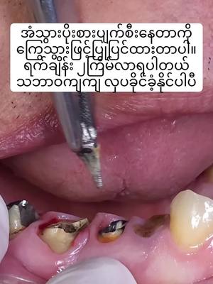 A post by @pearldentalclinic0 on TikTok caption: အံသွားတွေပိုးစားတာပြုပြင်မယ်#ပုလဲသွားဆေးခန်း #သွားဆေးခန်း 