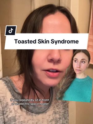 A post by @drdrayzday on TikTok caption: Beware of toasted skin syndrome. #toastedskinsyndrome #skinproblems #dermatologist @Alexandra Sedlak 