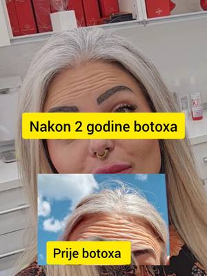 A post by @iam.beba.lo on TikTok caption: Ovo nije završni rezultat, ali bore su se smanjile i kad ga nemam 🥰🥰🥰🥰 i to me baš veseli. I veseli me činjenica da ste i Vi došli na konzultacije kod doktorice @Estetic dr. Anja  koja fenomenalno radi i priča tvojim jezikom tako da je sve razumijes😙😙  #botox #filer#doktorica 