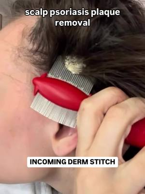 A post by @shereeneidriss on TikTok caption: If you love picking at your plaques on your scalp….this video is for YOU 🫵 practical tips and treatment recommendations for scalp psoriasis.  My newest YouTube video is live NOW and a deeper dive on Scalp Psoriasis 📺 #scalppsoriasis #psoriasis #dryscalp #scalphealth #plaque #dermatologist #shereeneidriss #dridriss  @ShereeneIdriss 