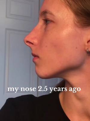 A post by @jess.malfoyy on TikTok caption: posting some more #drafts #nosejob #septorhinoplasty #shifttok 