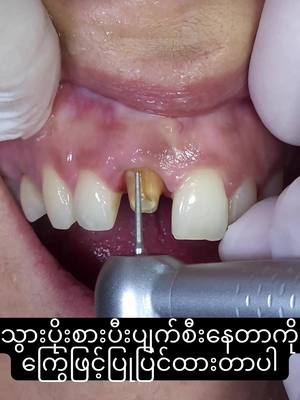 A post by @pearldentalclinic0 on TikTok caption: သွားပိုးစားပျက်စီးတာကိုပြုပြင်ခြင်း#ပုလဲသွားဆေးခန်း #သွားဆေးခန်း #သွားစိုက် 