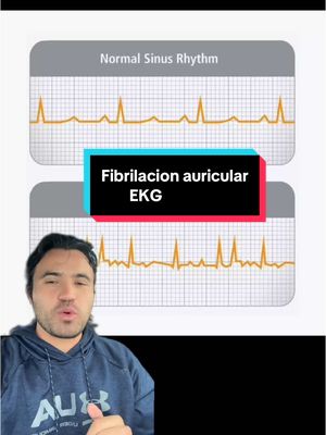 A post by @giovannydecastro on TikTok caption: Fibrilacion auricular #medstudent #medicina #estudiantedemedicina 