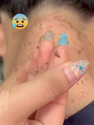 A post by @dimot93 on TikTok caption: For sensitive skin, take a look. This exfoliating ingredient is mild and does not irritate the skin. After use, the face is refreshing, silky and clean. Skin care products are better than absorption. It is more cost-effective to place an order for two now. #skincare #sheeureka #exfoliation #health PH1047