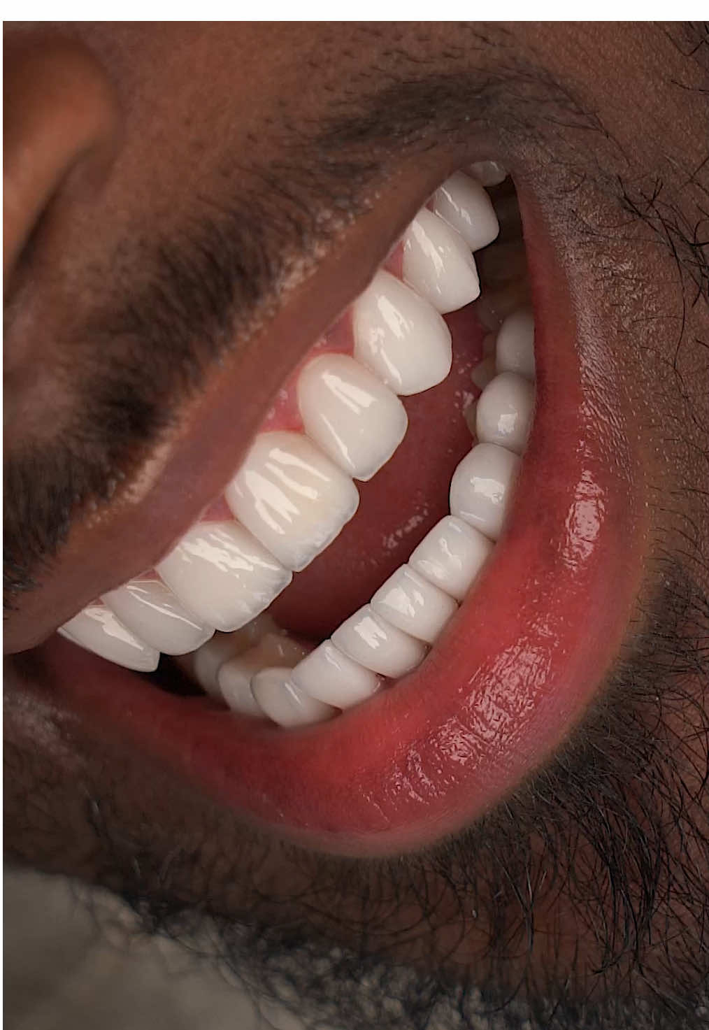 A post by @perfectsmileexperience on TikTok caption: Take a took at this mind blowing smile transformation 🤯💎 •100% porcelain Emax veneers •Completed in 3-4 days •Can last approximately 15-20 years •Minimal shaving in most cases •English Speaking staff •Travel package and concierge services available to plan your stay •Amazing Quality and prices! .  #veneers #porcelainveneers  #veneerscolombia #colombiaveneers #medellin #colombia #perfectsmile #dentallab #dentallaboratory #perfectsmileexperience #colombiadentist #bestveneers #dentist #cosmeticdentistry 