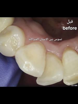 A post by @rahafjazbeh on TikTok caption: #فينيرز_cosmetic_dentistry_عيادة_اسنان_عيادات_اسنان_hollywood_smile #علاج_اللثة_والأسنان #قص_اللثه_وتجميلها #ليزر_اسنان #هوليود_سمايلveneer 