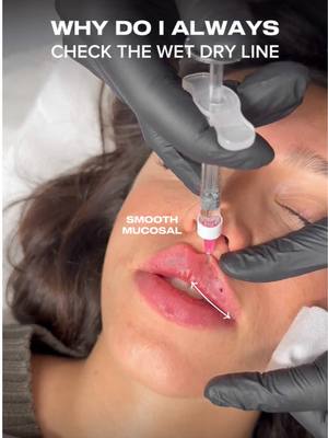 A post by @nataliepageaesthetics on TikTok caption: Why I Always Check the Wet-Dry Line When Injecting 🩶💉 The wet-dry line is crucial for achieving precise, smooth, and natural-looking lips. Here’s why: 	•	I check this line to ensure the filler is precisely packed, creating a seamless and even finish. 	•	If I see any slight indentation along the wet-dry border, it’s a sign that I need to add more to balance and perfect the shape. 	•	By keeping this area smooth and controlled, we avoid overfilling or migration, achieving that clean, natural definition my clients love. Want to master these techniques? Message “Flat Lips” for info on my signature masterclass! #lipfillers #flatlips  #russianlipsuk #flatlipsuk #russianlipstechnique #flatlipstechnique #lipfillerstraining #russianlipstraining #russianlipslondon #russianlips💉 