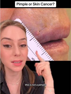 A post by @shereeneidriss on TikTok caption: Skin cancers can often be confused for pimples. Melanoma is the deadliest form of skin cancer and more people are diagnosed with skin cancer than all other cancers combined! This is why it's so important to get a skin check. Early detection and treatment is key to preventing the spread of basal cell carcinoma. #skincancer #pimple #skincancerawareness #sunscreenviral #melanoma #dermatologist #shereeneidriss #dridriss  @ShereeneIdriss 