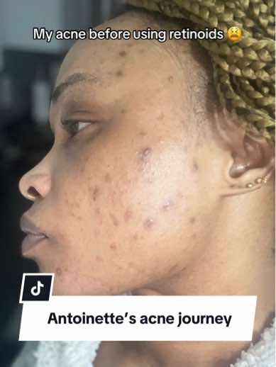 A post by @dermatica on TikTok caption: 🗣️ Name: Antoinette  ❤️ Skin concern: Acne ⏰ Treatment length: 8 months #acne #skincare #dermatology