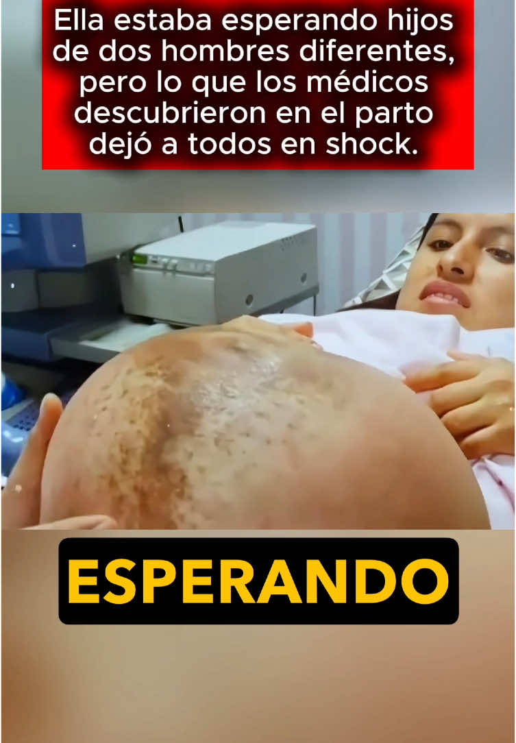 A post by @historiasraras00 on TikTok caption: Ella estaba esperando hijos de dos hombres diferentes, pero lo que los médicos descubrieron en el parto dejó a todos en shock. #usa #us #learnontiktok #truestory