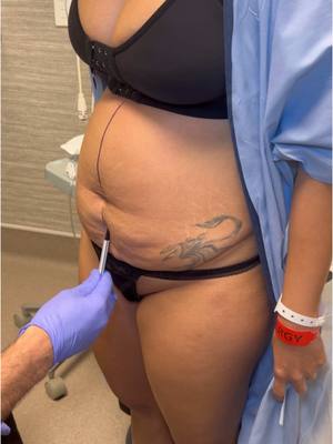 A post by @thenaturalresult on TikTok caption: #tummytuckjourney #tummytuck #skinremoval #afterpregnancy #plasticsurgery #plasticsurgeon 