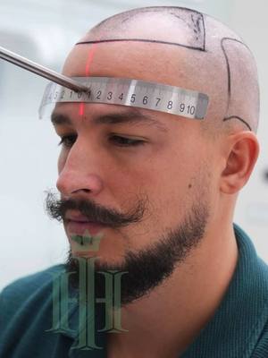 A post by @virgilthebarber on TikTok caption: Care styling mă avantajează cel mai mult ?🙏🏻 Cei interesați de implant- o să dau Tag clinicii - Dacă vreți reducere semnificativă , menționați numele meu👍 #virgilthebarber  #VERO @hairofistanbul 