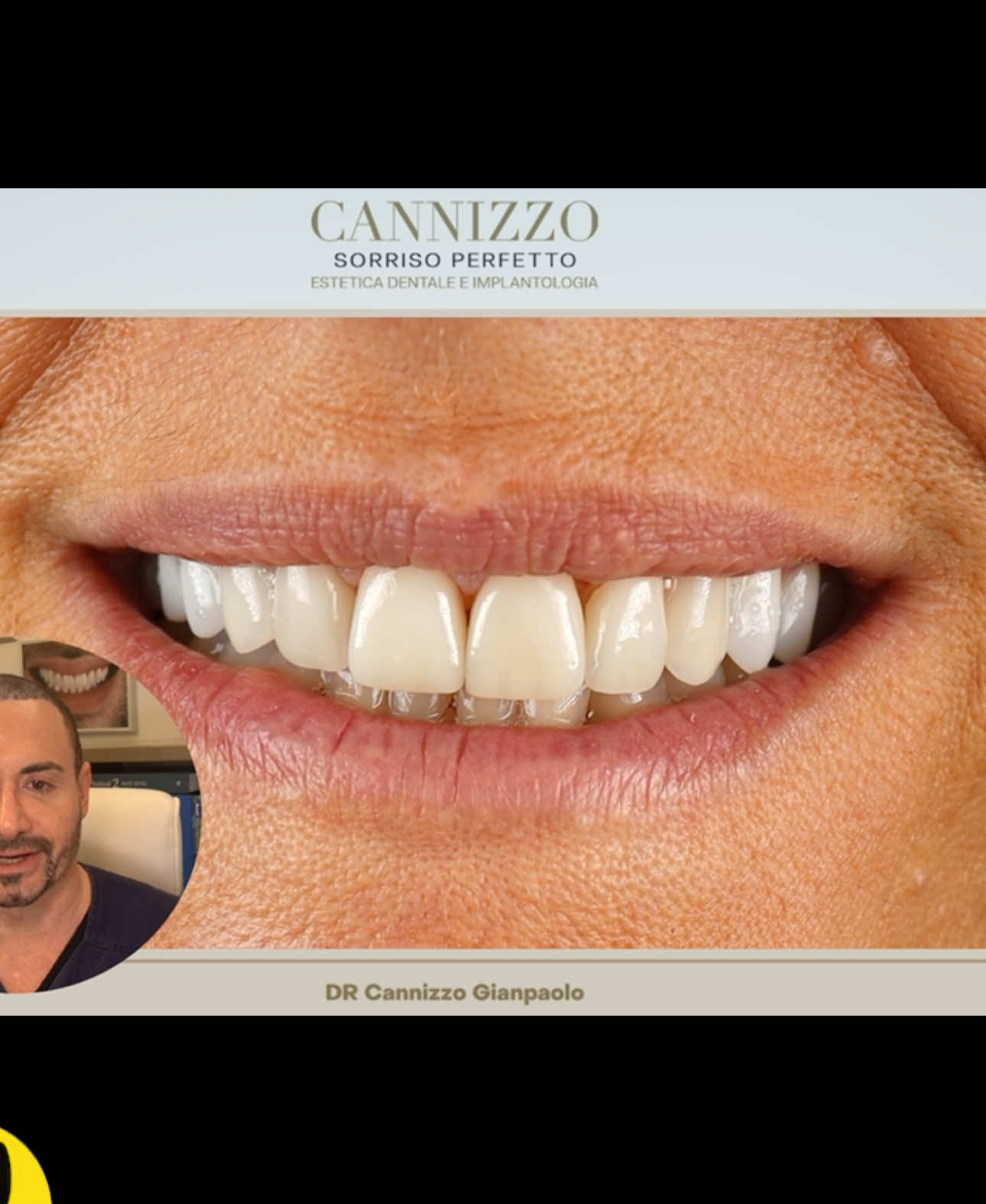A post by @cannizzostudio on TikTok caption: Anna ha ritrovato il suo sorriso, grazie al Dr. CANNIZZO #faccette #faccettedentali #dentifissi #impiantidentali #implantologiadentale #implantologia #esteticadentale #cannizzostudio #perte #neiperte #viral #virale #fyyy #fyy #fyyp 