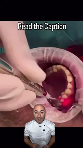 A post by @ on TikTok caption: Laser in Root Canal Treatment (Endodontics) Laser technology in endodontics is an innovative approach that enhances treatment outcomes, reduces post-operative pain, and improves the precision of root canal cleaning. In this method, lasers such as Er:YAG, Nd:YAG, and diode lasers are used for bacteria elimination, necrotic tissue removal, and even canal sterilization. Common Applications of Laser in Endodontics: ✔️ Removal of the smear layer ✔️ Root canal sterilization ✔️ Acceleration of periapical lesion healing ✔️ Opening of calcified canals ✔️ Control of pulpal bleeding
