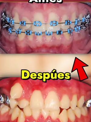 A post by @elduoantonyysanti on TikTok caption: ASI FUNCIONAN LOS BRACKETS! #curiosidades #mundocurioso #viral_video #datoscuriosos #humor #curiososdatos