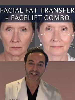 A post by @albertplasticsurgery on TikTok caption: Here’s an underrated combination you don’t hear of everyday— but delivers some of the most excellent, longest-term results 👀… 🌟 It’s a facial fat transfer + a facelift! 🌟 ▶ With age, a facelift alone may sometimes result in a “deflated” or “tight” look, especially in patients with lower body fat… ▶ A fat transfer is an incredible 2-in-1: it TAKES FAT from your own body (typically the abdominal area) and ADDS volume, recreating an appearance of youthfulness while removing wrinkles simultaneously! 🪄 ▶ Did we mention, it’s all done under local anesthesia? No need for grogginess or an extra expense! ✨ Ready to turn back time on your face? Consult with us today! 📞 (212)-203-8623 💻 www.albertplasticsurgery.com 📍 950 Park Avenue, New York, NY  #necklift #facelift #smasfacelift #deepplanefacelift #rhytidectomy #facialfattransfer #fatgrafting #fattransfer #PlasticSurgery #plasticsurgeon #AntiAging #antiwrinkle #beauty #aesthetics #cosmetics #collagen #lift #NYC #nycplasticsurgery #transformation #beforeandafter 