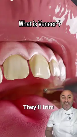 A post by @ on TikTok caption: Dental veneers #dentistdubai #dentist #dentalclinicdubai 