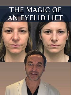 A post by @albertplasticsurgery on TikTok caption: A subtle, yet powerful, upper eyelid lift 👀👀 While many of my patients aim to fix aging in the face and neck, the upper and lower eyes are another one of the most prominent areas for visible (and oftentimes, even uncomfortable!) signs of aging and even hooded eyelids!  Eyelid surgery, or a Blepharoplasty is excellent for addressing: ▶ Excess skin ▶ Sagging skin ▶ Crepey skin ▶ A drooping appearance ▶ Large bags under your eyes (lower bleph) Ready to turn back time on your face? Consult with us today! 📞 (212)-203-8623 💻 www.albertplasticsurgery.com 📍 950 Park Avenue, New York, NY  #eyelids #eyesurgery #eyes #blepharoplasty #upperepharoplasty #lowerblepharoplasty #AntiAging #hoodedeyelids #hoodedlids #NYC #PlasticSurgery #nycplasticsurgeon #nycplasticsurgery 