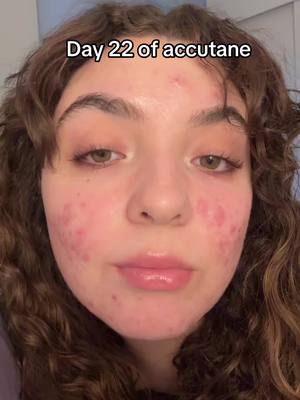 A post by @kristenrodr02 on TikTok caption: I need to redness to go away NOOOOW… when does that happen 😫 #accutane #relatable #acne 