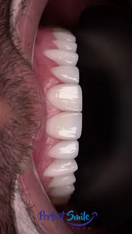 A post by @perfectsmileexperience on TikTok caption: The natural look 💎! . •100% porcelain Emax veneers •Completed in 3-4 days •Can last approximately 15-20 years •Minimal shaving in most cases •English Speaking staff •Travel package and concierge services available to plan your stay •Amazing Quality and prices! .  #veneers #porcelainveneers  #veneerscolombia #colombiaveneers #medellin #colombia #perfectsmile #dentallab #dentallaboratory #perfectsmileexperience #colombiadentist #bestveneers #dentist #cosmeticdentistry 