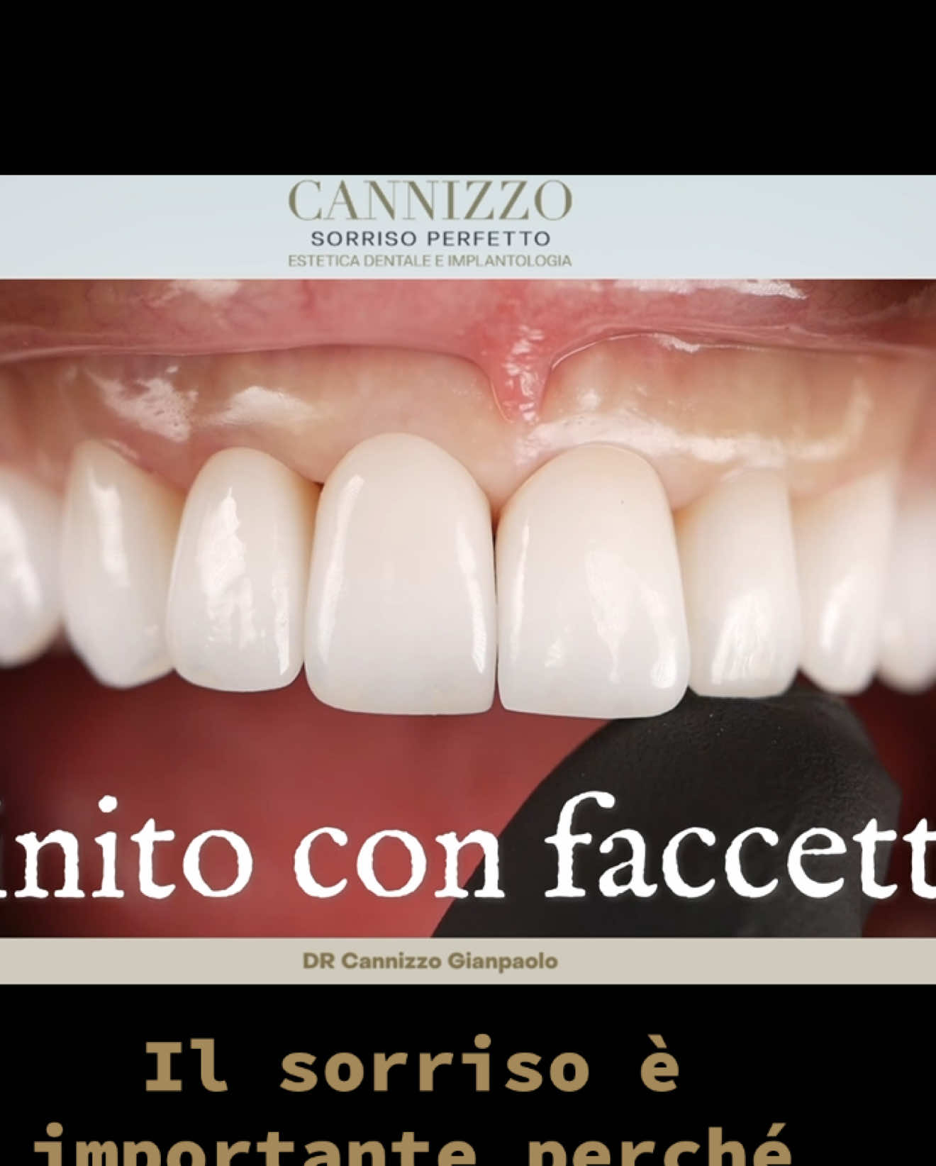 A post by @cannizzostudio on TikTok caption: Le faccette dentali migliorano estetica, colore e forma del sorriso rapidamente. Dr.CANNIZZO Gianpaolo 🦷 #faccette #faccettedentali #esteticadentale #sorriso #dentibianchi #dentibianchichallenge #veeners #cannizzostudio #fyyy #fyy #fyy #fyyp #neiperte #perte #viral #virale 