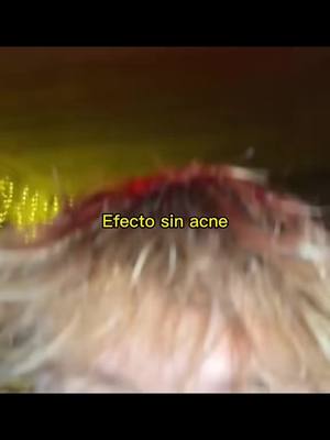 A post by @iambrann on TikTok caption: Efecto Sin Acne