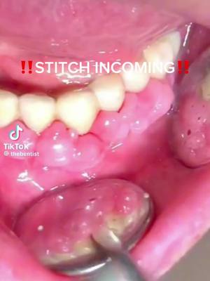 A post by @simplenursing on TikTok caption: Let's learn about gingival hyperplasia! Stitched with @thebentist Learn in more detail using our study guide books! Comment "book" and we will send you the link to purchase. Each page links directly to our membership video content to accompany your book with a detailed lesson 🙌 . . . #nursingschool #nursing #medical #nclex