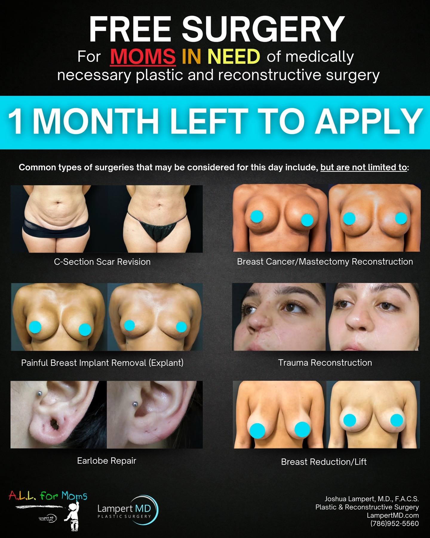A post by @lampertmd on TikTok caption: Mothers who are income-eligible and uninsured/underinsured, this is your chance for FREE reconstructive surgery to resolve a medically necessary issue at A.L.L For Moms Charity Surgery Day hosted by Lampert MD Plastic Surgery! NOW OPEN NATIONALLY.  ⏰ Deadline approaching fast – Apply by April 21, 2025 ⏰ To Apply: 1) Go to my website by clicking the link in my bio and click on the Apply button on the top bar. 2) Scroll down, review the rules, and download the application form. 3) Submit the required material by the deadline. ❌NO DM SUBMISSIONS❌ If you have additional questions, call our office at (786)952-5560 or email brianna@lampertmd.com  Don’t miss out on this incredible opportunity. Apply today, and let’s make this Mother’s Day unforgettable! ❤️ ........ #charitysurgeryday #reconstructiveplasticsurgery #reconstructivesurgerymiami #miamiplasticsurgeon #lampertmd #breastreconstruction #scarrevision #brokennose #plasticsurgerymiami #explant #csectionscar #facialreconstructivesurgery #burnscar #mommymakeover #charitysurgery #reconstructivesurgery #charity #cancerreconstructionsurgery #helpingmoms #helpingmom #explant #explantsurgery #rhinoplasty #plasticsurgery #miamiplasticsurgeon #breastcancerreconstruction #momsofinstagram #momstrong #allformomscharity #allformomscharitysurgeryday