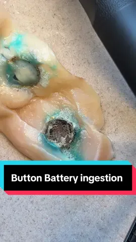 A post by @mortuivivosdocent127 on TikTok caption: Replying to @Panda 🐼 I had a few people mention doing an experiment and I’m always down for that. Just remember, this is a sliced piece of meat. A child’s esophagus is only a few millimeters thick, so you can imagine the damage this would do to their insides. Also, the chicken was disposed of so that no animals could get into it, that seems responsible. #autopsy #autopsytech #paramedic  #batterysafety #experiment #safety #foryou #foryoupage #fyp #learnontiktok 