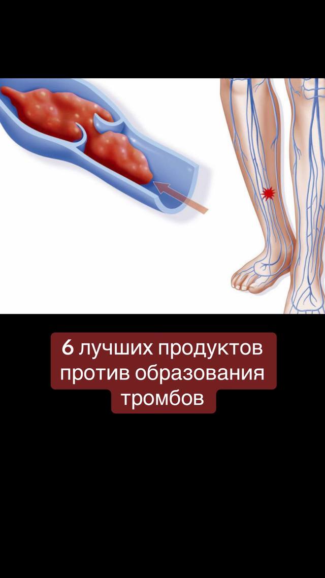 A post by @jurnal_sdorovja on TikTok caption: 1. Чеснок. В чесноке содержатся фитонциды, оказывающие оздоровительное влияние на сердечно-сосудистую систему. Чеснок нейтрализует шлаки и токсины и тем самым предотвращает возникновение кровяных тромбов.  2. Черная смородина. Витамин С находится в черной ягоде, которая также богата медью, серой, серебром. К тому же, витамин С содержится и в листьях смородины. Примечательно также, что ягода способна повысить тонус сосудов, а также укрепить сердечную мышцу.  3. Рыба. Польза такого продукта как рыба заключается в жирных кислотах Омега-3. В этом особенно нуждается головной мозг. При использовании продуктов с содержанием жирных кислот активизируются обменные функции между мембранами клеток. Такие положительные изменения предотвращают возникновение тромбоза.  4. Имбирь. Имбирь один из лучших натуральных разбавителей крови – он снижает давление и обеспечивает нормализацию кровотока. Однако если употреблять имбирь редко и в минимальной дозировке, продукт оказывает только профилактическое действие и не устраняет вязкость крови.  5. Льняное масло. Льняное масло - еще один источник омега-3 жирных кислот. Среди других растительных продуктов он считается самым полезным.  6. Горчица. Горчица – еще один продукт, содержащий омега-3 и витамин В6, которые обеспечивают: снижение вязкости крови; очищение кровеносной системы; укрепление сосудов. 🍎ЖУРНАЛ ЗДОРОВЬЯ🍏  #тромбоз #тромбозвен #здоровоепитание #здоровоетело #здоровье #сердечнососудистаясистема #зож 