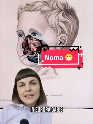 A post by @keine.erinnerungskultur on TikTok caption: In Europa gab's im 20. Jahrhundert kaum Fälle von Noma - außer in den Lagern der Nazis.
