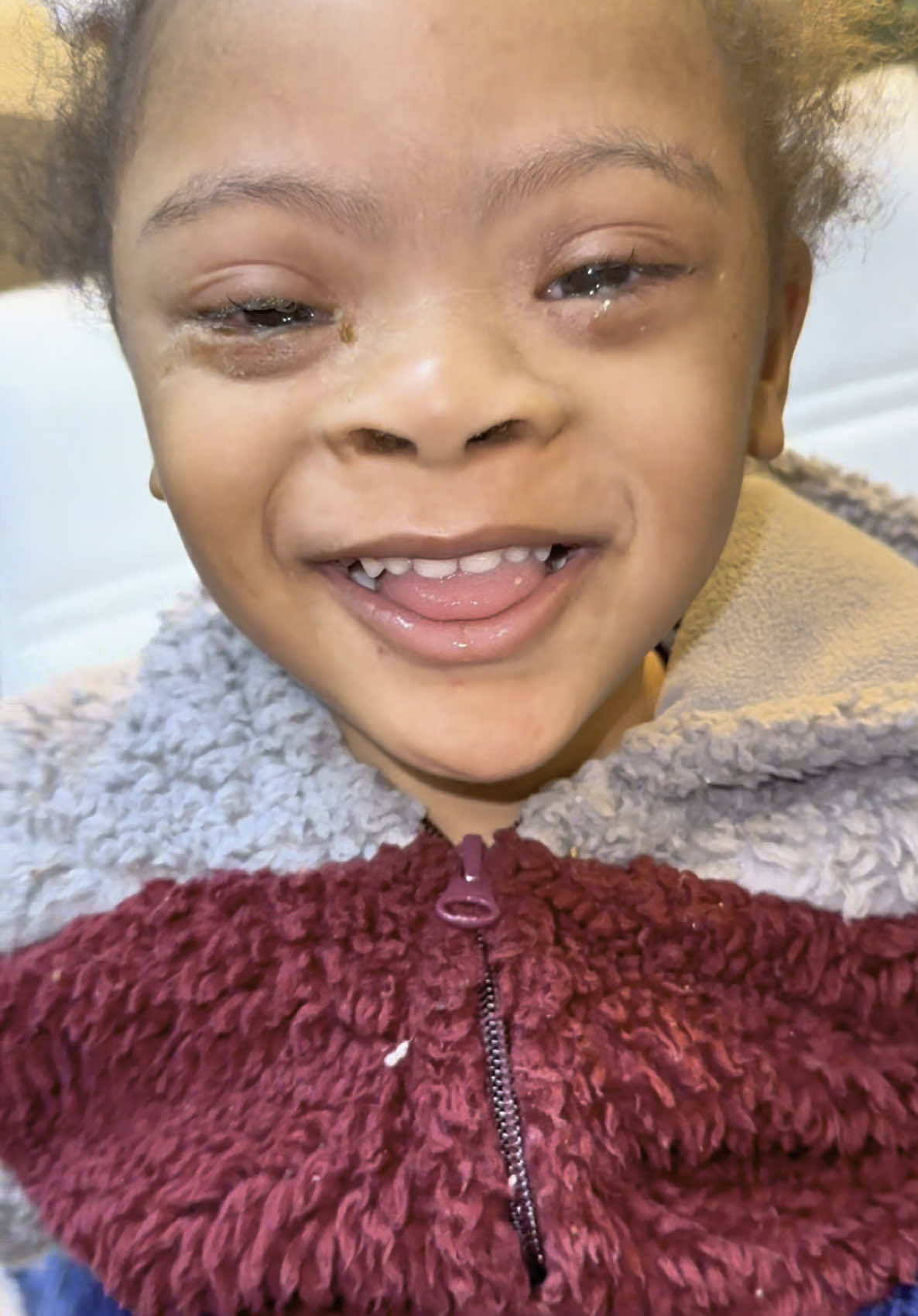 A post by @beautdeeandthebunch on TikTok caption: We got a call from Jayceons school saying he was oozing from he’s eyes. They said it looked like the beginning of pink eye. He came home & took a nap & woke up like this 😩