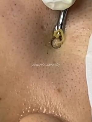 A post by @pimple.satisfy on TikTok caption: #cejour-là #ConSantanderConecto #explore #fyp #foryou 