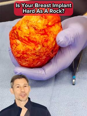 A post by @lampertmd on TikTok caption: If your breast implants feel hard as a rock and are causing pain, you may be experiencing Grade 4 Capsular Contracture. This common complication after breast enlargement surgery can lead to implant deformity, pain, and discomfort. In this video, we dive deep into what capsular contracture is, how it’s classified using the Baker’s Classification System, and what you can do if you suspect you have it. Learn about the various theories behind why capsular contracture occurs, including foreign body reactions, bacterial infections, and genetic predispositions. We also discuss the risks of recurrence and the potential treatments available to manage this condition, including implant removal or replacement. If you're worried about capsular contracture or want to explore your treatment options, consult with a board-certified plastic surgeon to understand the best course of action for you. #ExplantSurgery #BreastImplantRemoval #PlasticSurgery #BreastDeformity #miamiplasticsurgeron #plasticsurgery #plasticsurgeon #plasticsurgeonsoftiktok #plasticsurgeonexplains 