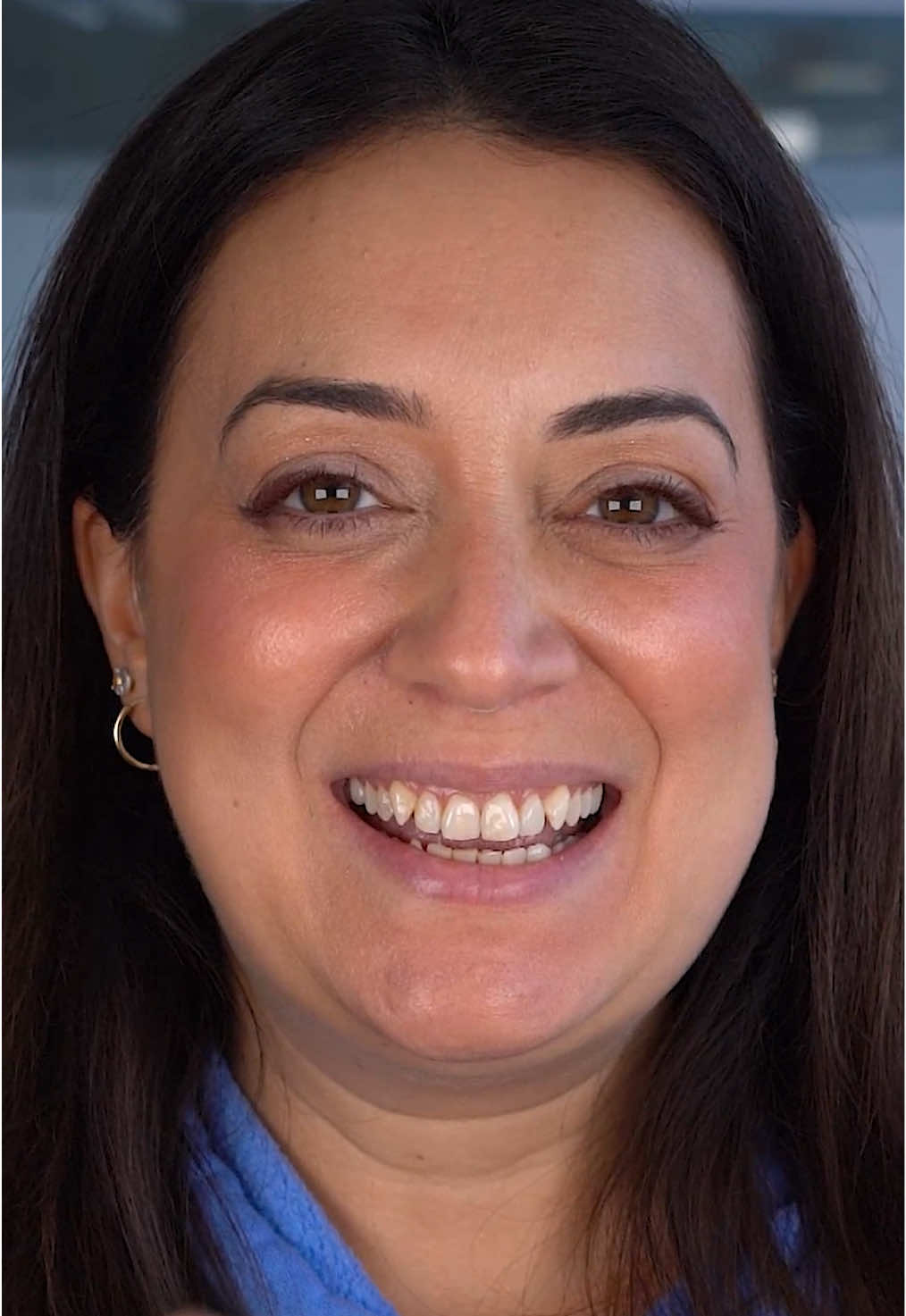 A post by @perfectsmileexperience on TikTok caption: A gorgeous smile transformation for our lovely patient visiting from New Jersey 🇺🇸. . •100% porcelain veneers •Completed in 3-4 days •Can last approximately 15-20 years •Minimal shaving in most cases •English Speaking staff •Travel package and concierge services available to plan your stay •Amazing Quality and prices! .  #veneers #porcelainveneers  #veneerscolombia #colombiaveneers #medellin #colombia #perfectsmile #dentallab #dentallaboratory #perfectsmileexperience #colombiadentist #bestveneers #dentist #cosmeticdentistry 