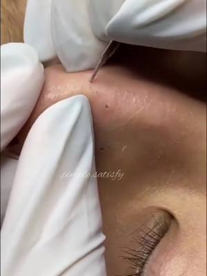 A post by @pimple.satisfy on TikTok caption: Amasing vedio ❤️#foryou #fyp #explore #cejour-là 