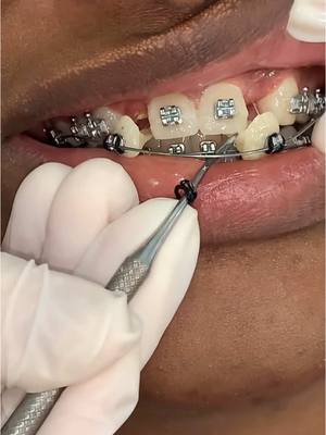A post by @thebentist on TikTok caption: His Teeth POPPED Right Out! 😮🦷 #teeth #braces #dentist 