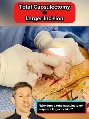A post by @lampertmd on TikTok caption: This video shows a comparison of two implants from the same patient! One with a heavily calcified Baker Grade 4 capsule and the other with a soft, flexible capsule. 🔔 Watch to see why incision size matters in total capsulectomy! #ExplantSurgery #BreastImplantRemoval #plasticsurgery 