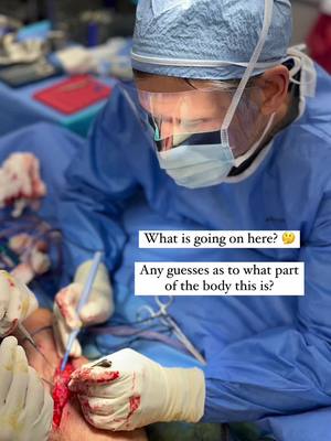 A post by @lampertmd on TikTok caption: FOR EDUCATIONAL PURPOSES: Reconstructive leg surgery after unfavorable skin graft. This patient was not happy with the appearance of his shin skin graft following an accident, and he complained it was painful. The plan: Reconstruction of left lower extremity Multiple scar revisions Excision of skin grafts Fat transfer to the leg #PlasticSurgery #reconstruction #reconstructivesurgery #legsurgery #fattransfer #skingraft #boardcertifiedplasticsurgeon #miami #miamiplasticsurgeon 