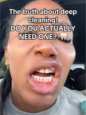 A post by @thebentist on TikTok caption: The Truth About DEEP Teeth Cleanings! 😭🦷 #teeth #braces #dentist 