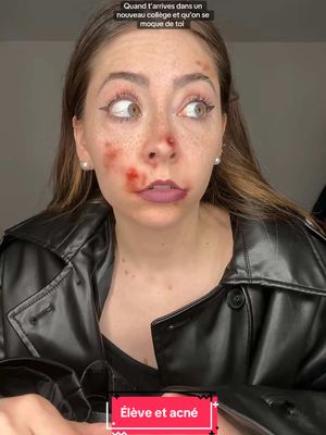 A post by @shayvise on TikTok caption: Si toi aussi t’en as marre de voir tes boutons briller sur ta peau, pense aux patchs @Garnier ! #garnierfr #garnierskincare 